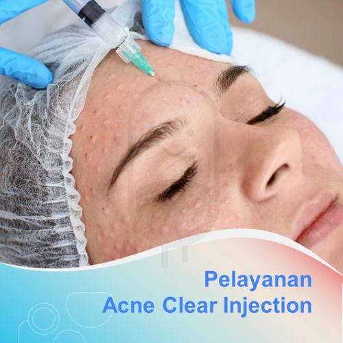 ACNE CLEAR INJECTION VOUCHER LAYANAN - KLINIK SINTYA