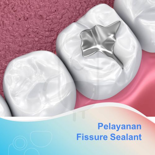 FISSURE SEALANT - KLINIK MR CEGER