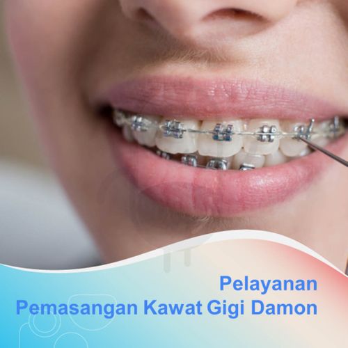 PEMASANGAN KAWAT GIGI DAMON - KLINIK STELLA MEDIKA