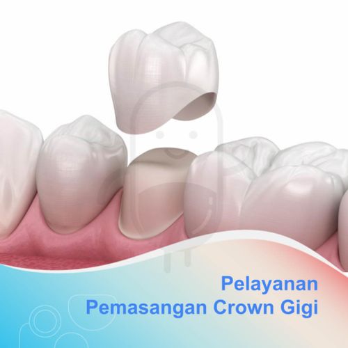 PEMASANGAN CROWN/MAHKOTA GIGI - KLINIK KENDEDES