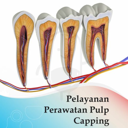 PERAWATAN PULP CAPPING - KLINIK STELLA MEDIKA 1